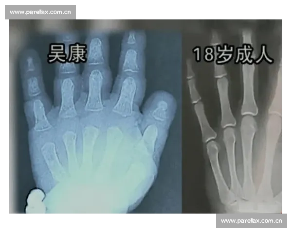 18 岁骨骺线未闭合？科学 3 招助你再长高 5cm